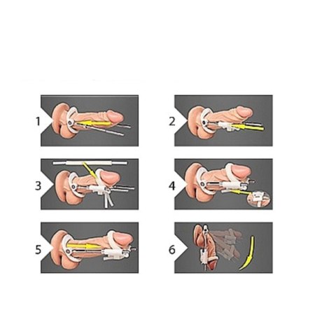 Penis Extender - White Pumped